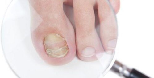 Diagnosticul ciupercii
