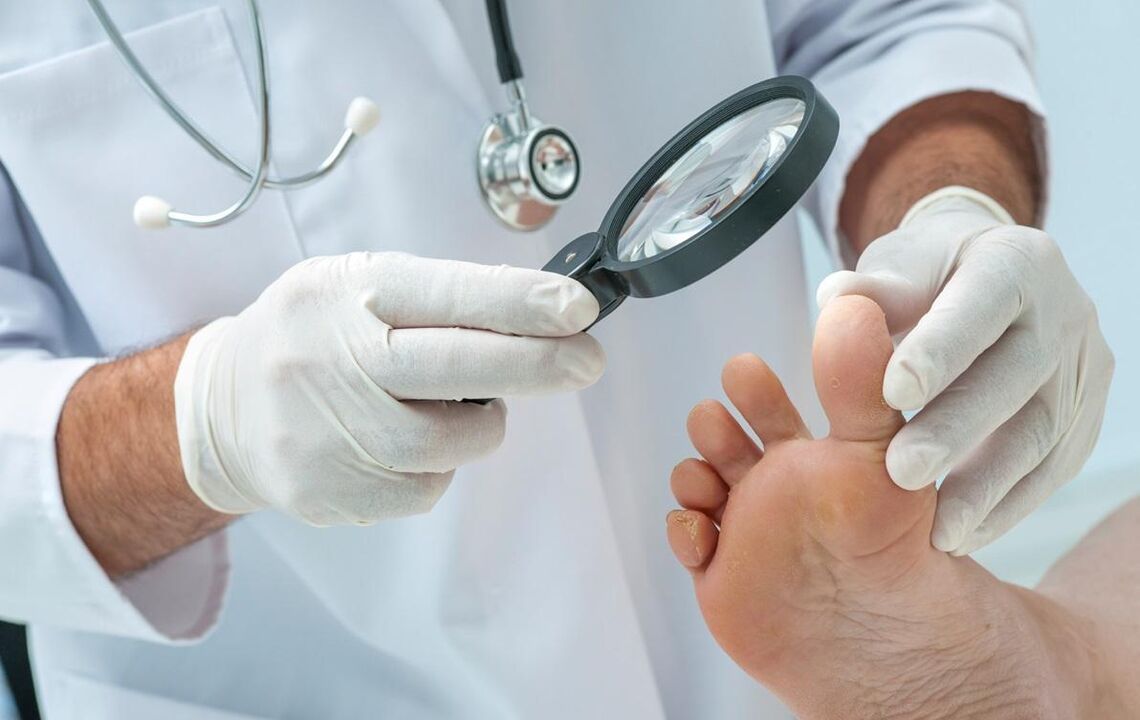 medicul examinează unghiile pentru ciupercă