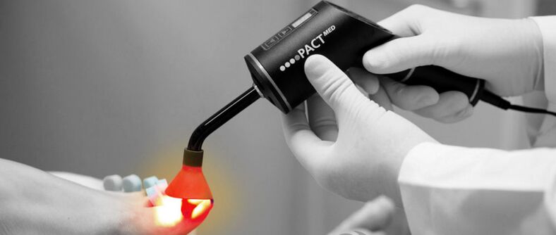 tratament cu laser pentru ciuperca de pe unghiile picioarelor